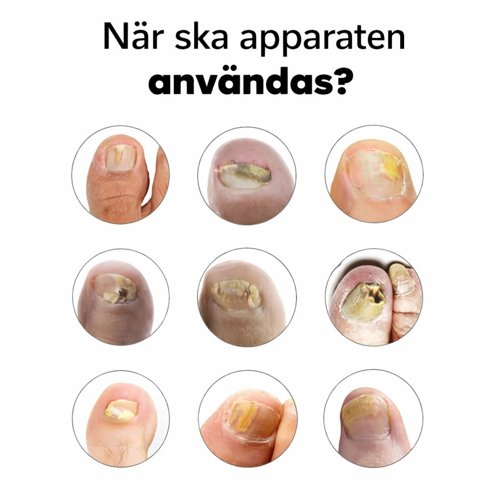 DermalPulse™ - Effektiv behandling för nagelsvamp